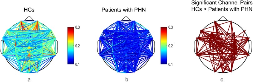 Three brain network diagrams compare healthy controls (HCs) and patients with PHN. Diagram a shows extensive connections with varying colors from blue to red indicating connection strength up to 0.3. Diagram b is predominantly blue, suggesting weaker connections in PHN patients. Diagram c highlights significant channel pairs in red, where connections are stronger in HCs than in PHN patients. A color scale bar accompanies the diagrams.