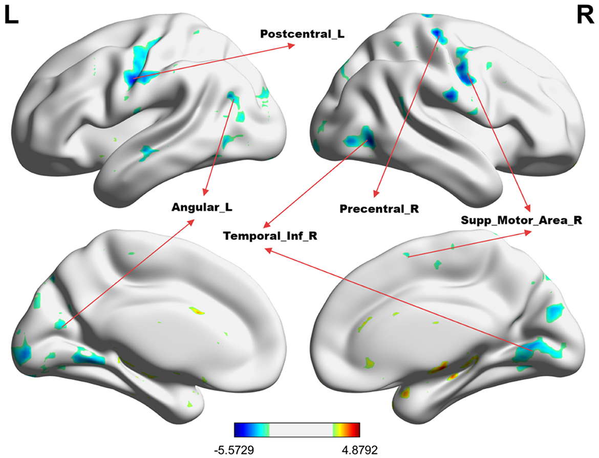 Brain activity map on four 3D brain models labeled L and R indicating left and right hemispheres. Areas highlighted include Postcentral_L, Angular_L, Precentral_R, Temporal_Inf_R, and Supp_Motor_Area_R. A color scale from blue to red represents activity intensity, ranging from −5.5729 to 4.8792.