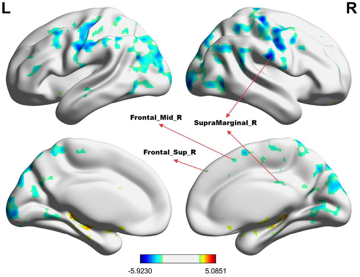 Brain imaging showing surface maps of the left and right hemispheres. Blue to red color scale indicates statistical values, with annotations on the right hemisphere pointing to Frontal_Mid_R, SupraMarginal_R, and Frontal_Sup_R regions.