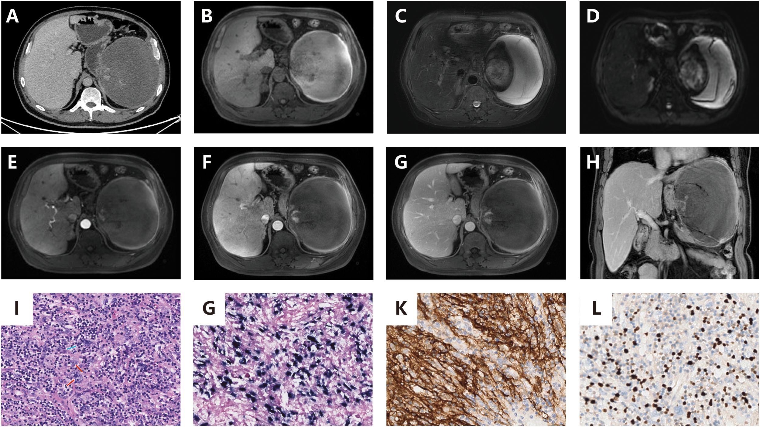 Panel of medical images and histology slides: A to H show a series of CT and MRI scans of the abdomen, highlighting a large mass on the liver. I to L show microscopic views of tissue samples with varying staining patterns, indicating cellular details and potential disease markers.