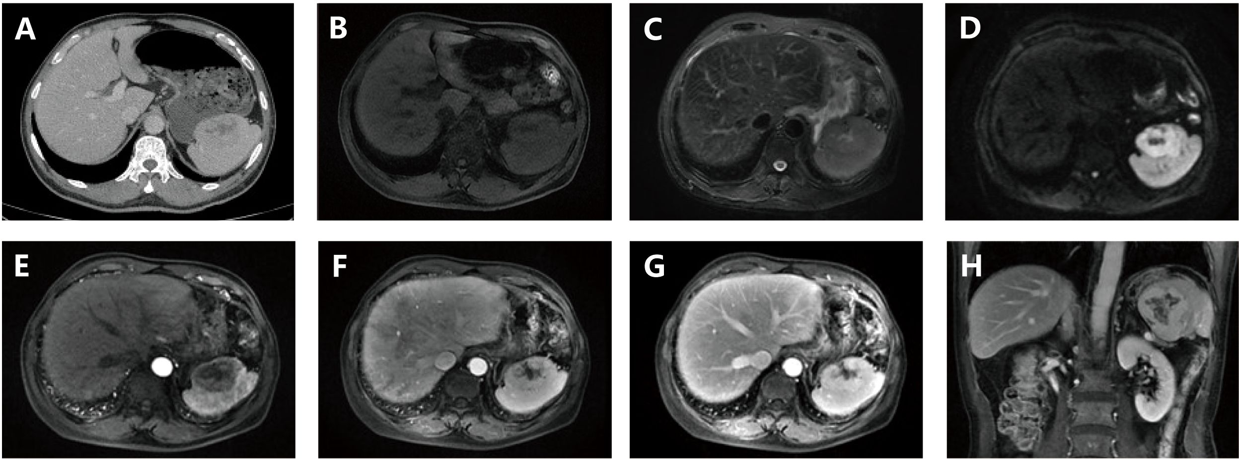 A series of eight medical imaging scans labeled A to H, depicting liver and abdomen views. A is a CT scan; B to H are MRI images, showing various contrasts and angles. Different tissues and structures are highlighted in each image, illustrating the internal anatomy with differing clarity and detail.