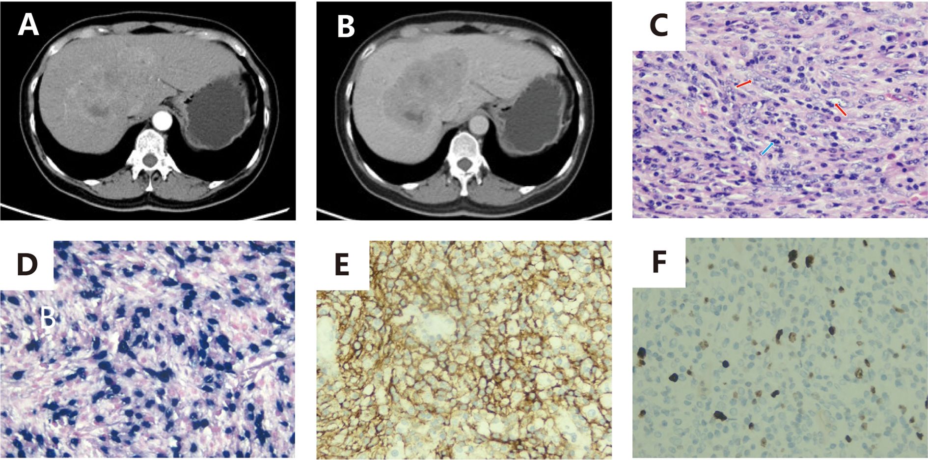 CT scan images show different phases: A (axial view) and B (portal venous phase). Microscopic images C and D display tightly packed cells with varying nuclei staining. Image E shows a brown-stained immunohistochemical pattern. Image F illustrates cells with some dark-staining nuclei.