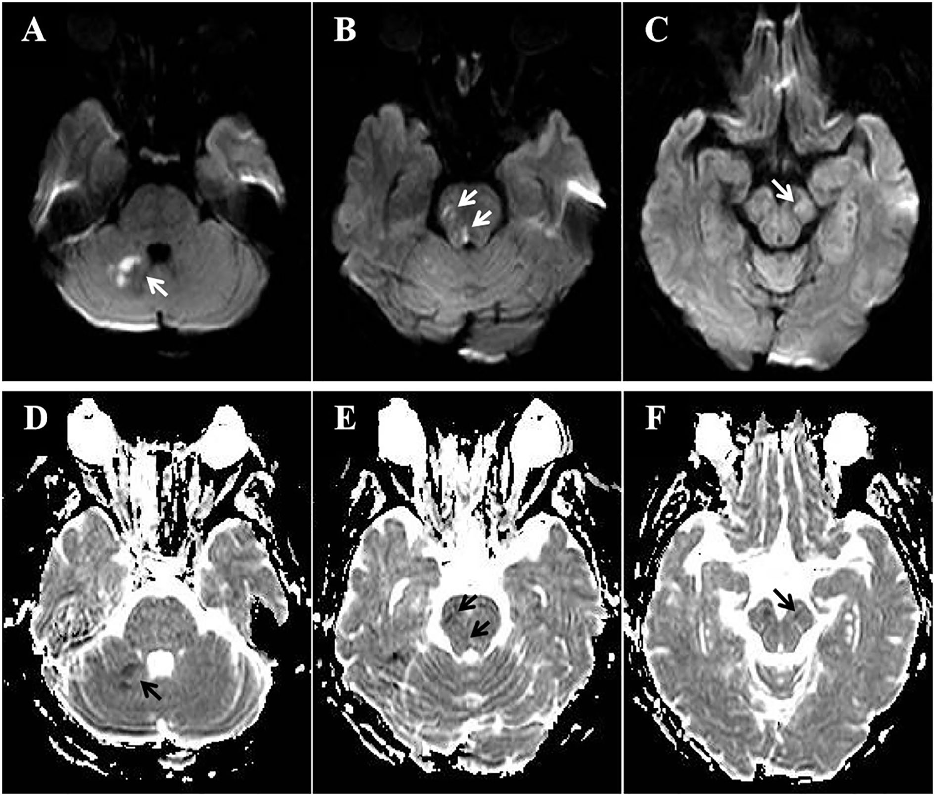MRI scans show axial brain images in two rows. The top row (A-C) highlights bright spots on diffusion-weighted images with white arrows indicating infarctions in the cerebellum and brainstem. The bottom row (D-F) features corresponding apparent diffusion coefficient images with black arrows pointing to similar areas. Each image demonstrates distinct parts of the brain for medical analysis.