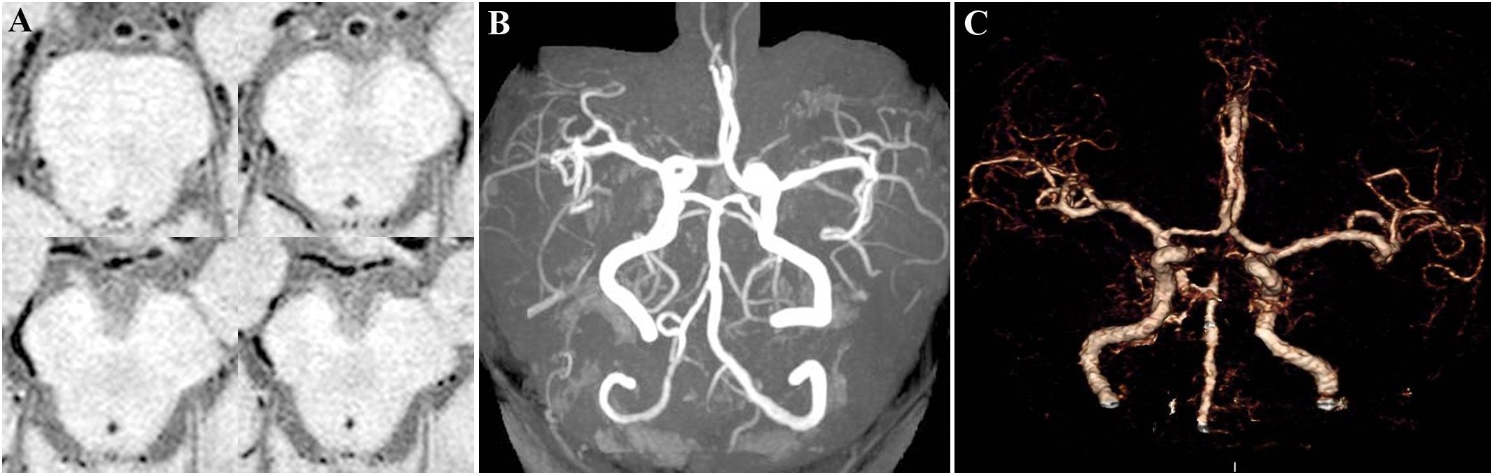 Panel A shows four axial vessel wall imagings of basilar artery and bilateral posterior cerebral arteries, revealing mild stenosis with minor atherosclerotic plaques on the vessel walls. Panel B displays a MR angiography highlighting complete recanalization of basilar artery and bilateral posterior cerebral arteries in white against a dark background. Panel C presents CT angiography revealling occlusion at the apex of basilar artery upon admission, in comparison with Panel B.