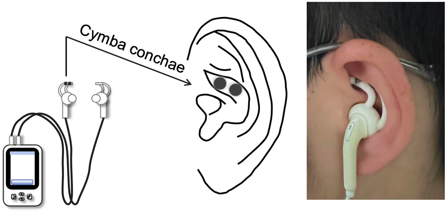 Diagram displaying the use of a transcutaneous auricular vagus nerve stimulation (taVNS) device. Includes a detailed view of the device, a schematic connection to an earbud-like object, and an image showing the device positioned inside a person's ear at the cymba conchae.