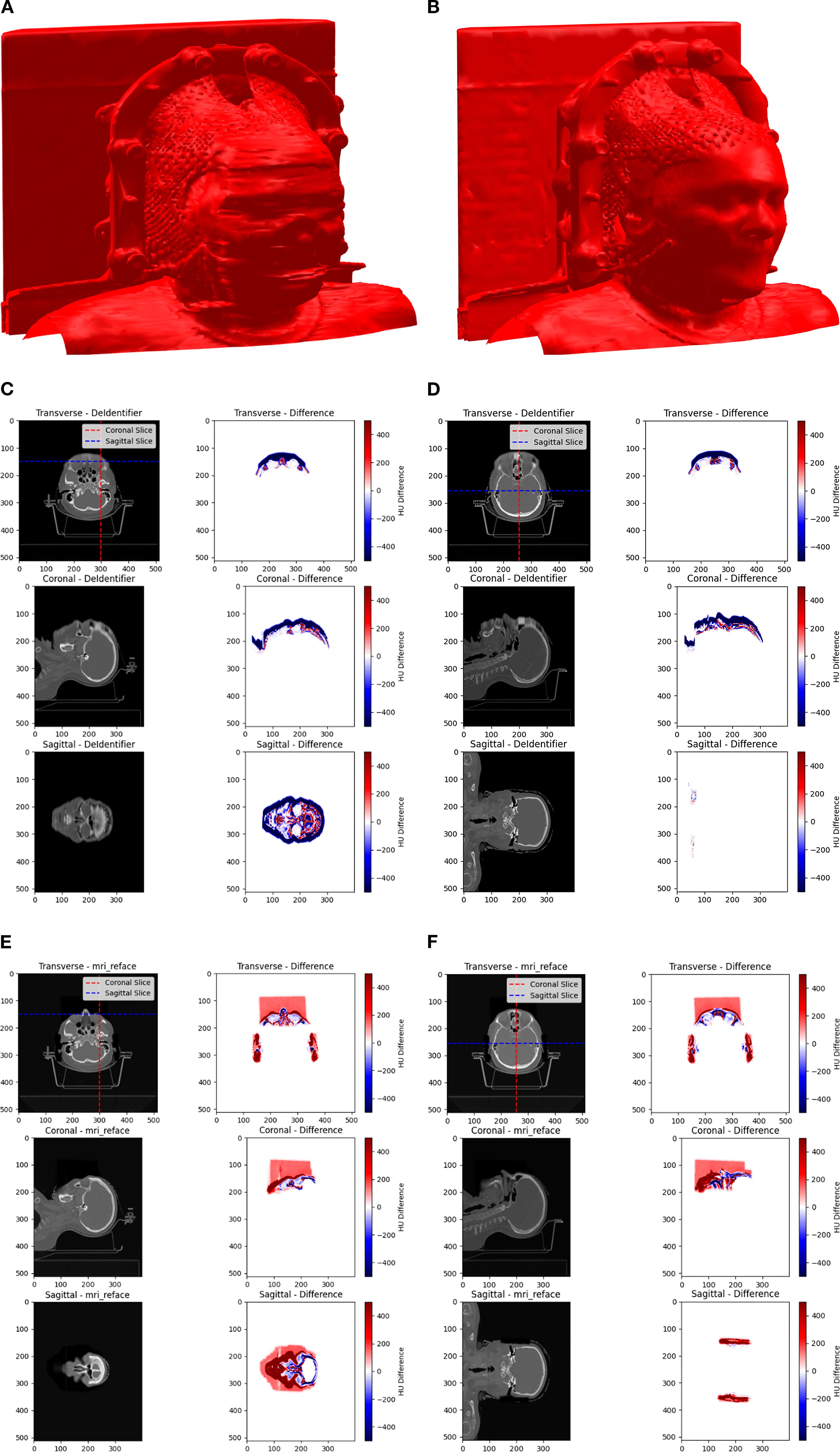 Two sets of 3D head models appear at the top, labeled A and B. Below them are four sets of CT images labeled C, D, E, and F. Each set contains transverse, coronal, and sagittal views showing results of either the DeIdentifier or mri_reface process. Difference images are displayed on the right, highlighting variations in red and blue, with a color scale from -400 to 400.