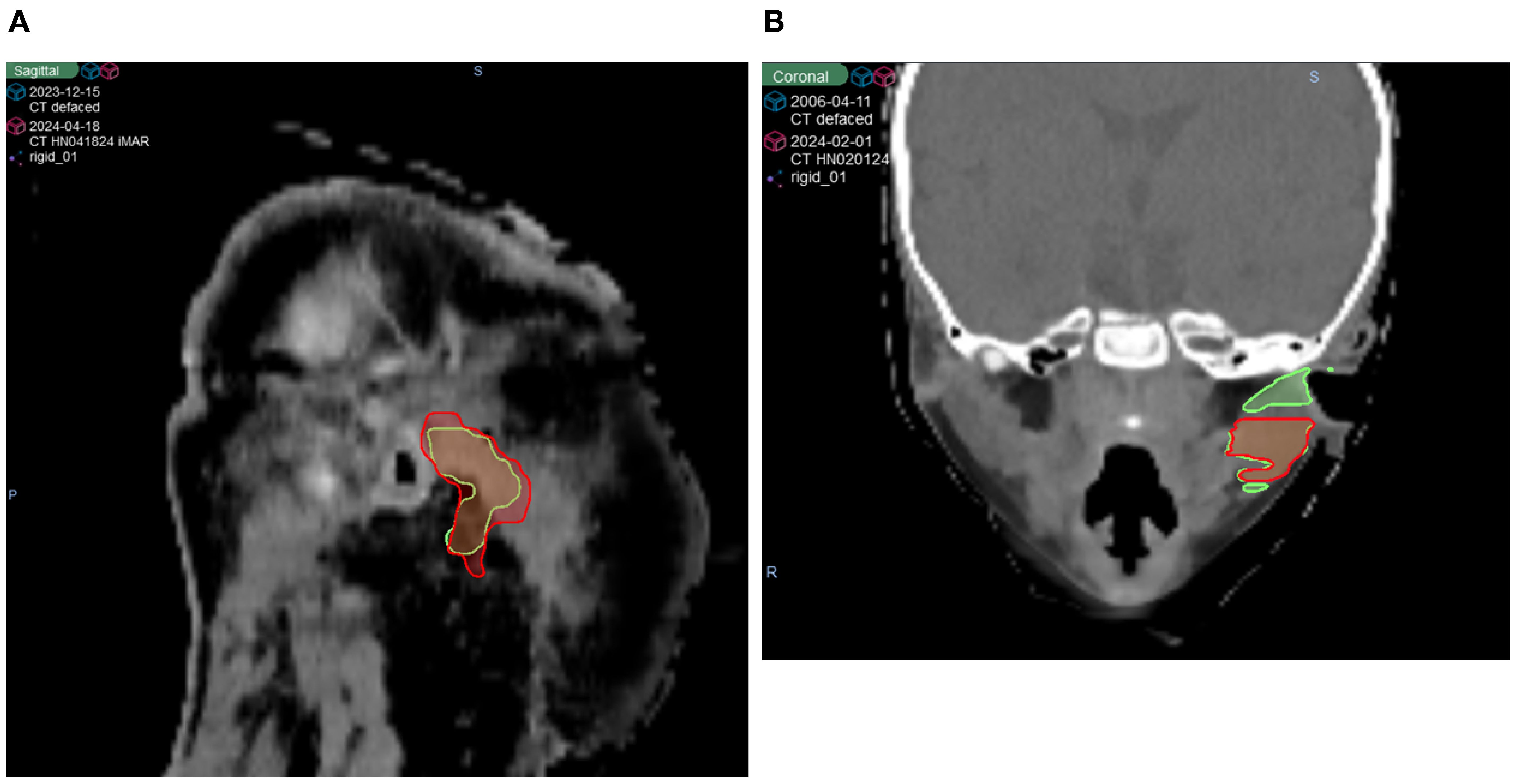 CT scans displayed in two panels. Panel A shows a sagittal view with regions outlined in red and green, highlighting a specific area. Panel B shows a coronal view with similar outlines, indicating different sections, likely for medical analysis or comparison. Both panels include labeled dates and identifiers for reference.