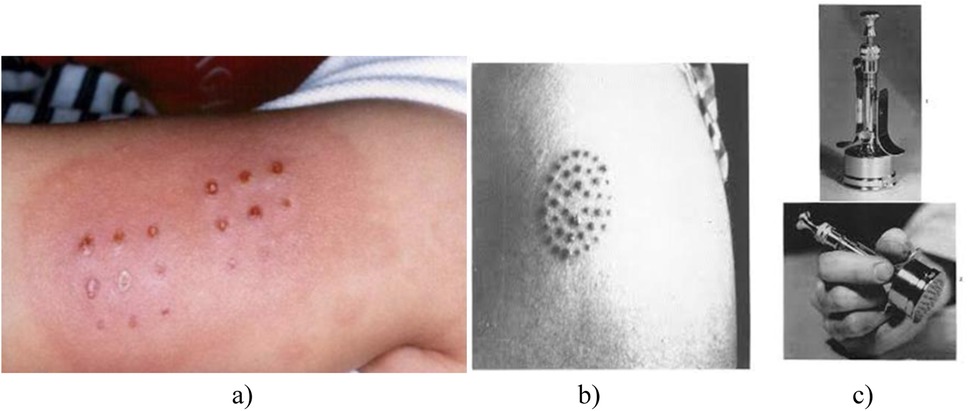 Image (a) shows a forearm with several small, red, raised bumps arranged in a grid pattern likely from a skin test or vaccine reaction. (b) shows a similar pattern of circular marks on an arm, likely also from a vaccination. (c) depicts a multi-needle vaccination device, the upper photo shows it standing upright, and the lower shows a hand holding it.