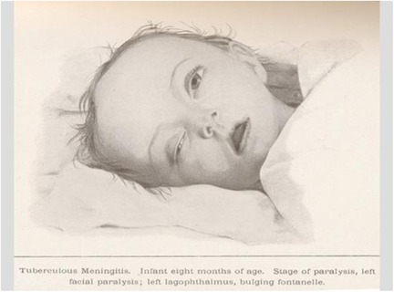 Illustration of an eight-month-old infant with tuberculous meningitis. The child shows signs of facial paralysis, left-sided lagophthalmos, and a bulging fontanelle.