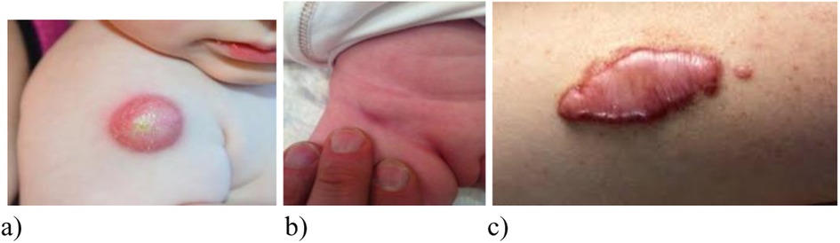 Panel (a) shows a close-up of an infant's upper arm with a large, raised, inflamed lesion. The lesion is circular, red, and swollen with a shiny surface and a central yellow area, indicating pus accumulation suggestive of an abscess or localized infection, likely following vaccination or skin trauma.Panel (b) shows a baby’s ankle or wrist area being examined. The skin appears red and mildly swollen with a localized induration. There is no open wound or visible pus, but the area shows early signs of inflammation, possibly due to cellulitis or a mild reaction to an injection.Panel (c) shows an adult’s skin with a pronounced keloid scar. The scar is thick, raised, and elongated, with a shiny pinkish surface extending beyond the original wound margins. The surrounding skin appears slightly dotted but otherwise unremarkable, indicating abnormal healing or excessive collagen deposition.