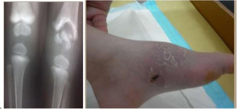 X-ray of two knees showing bone abnormalities, accompanied by a photo of a foot with dry, peeling skin and a small dark lesion on the heel.