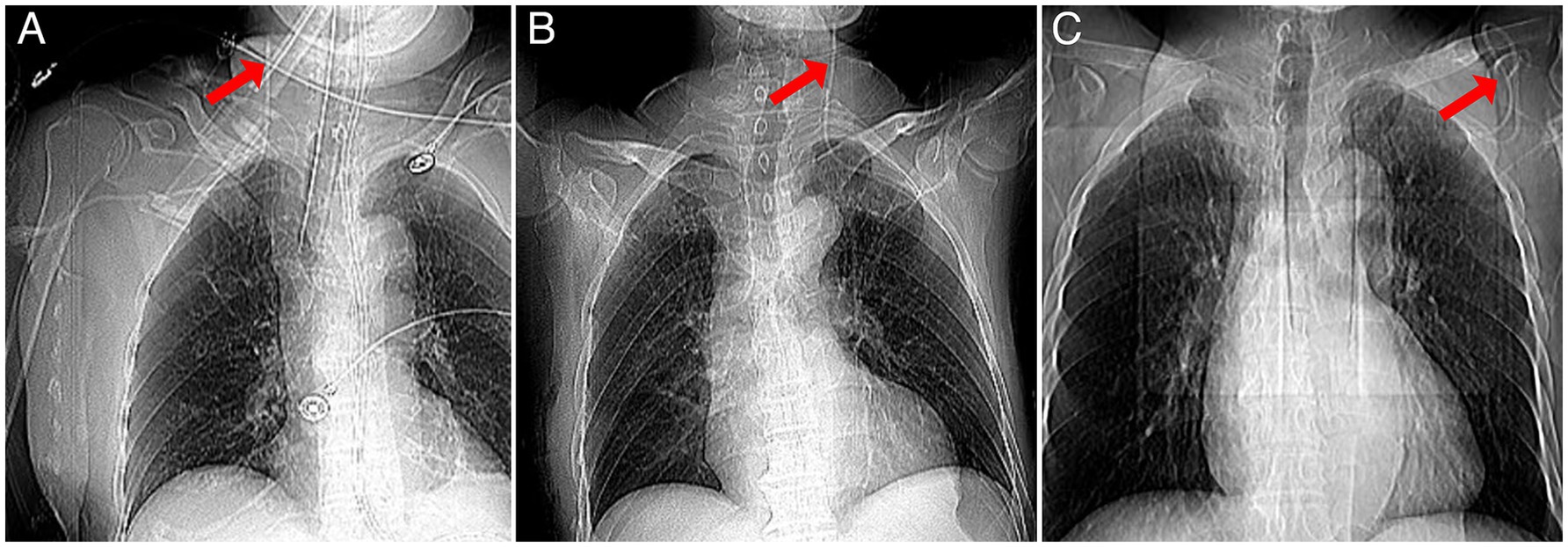 Three chest X-ray images labeled A, B, and C show placements of a medical tube. Each image has a red arrow pointing to the tube near the neck region, indicating its position. The images display different angles and views of the chest cavity and surrounding structures.