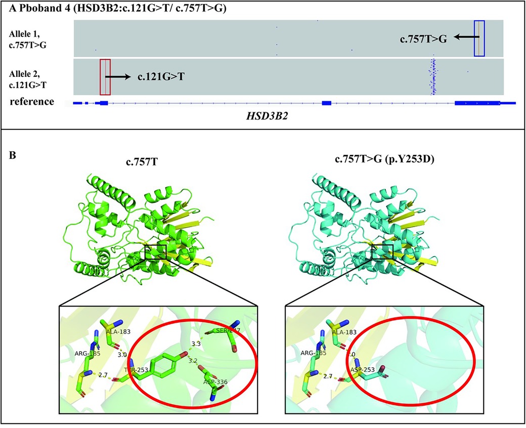 Diagram showing HSD3B2 gene variations. Panel A indicates alleles c.757T>G and c.121G>T with reference sequence alignment. Panel B displays protein structures for c.757T and mutated c.757T>G (p.Y253D), highlighting the molecular interactions with a red circle, involving ALA-183, ARG-185, and ASP-336 in wild type, and ASP-253 in the mutant.