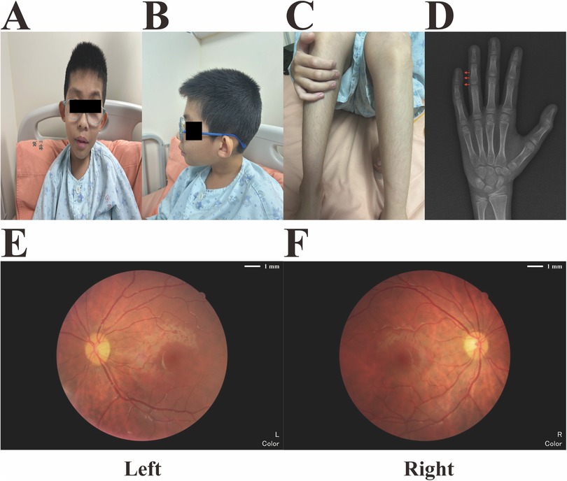 A collage of six images labeled A to F. A and B show a child in a hospital gown from the front and side, with faces obscured. C displays the child's arms and legs. D is an X-ray of a hand with a highlighted area. E and F are retinal images labeled left and right, showing detailed blood vessels and optic nerves.