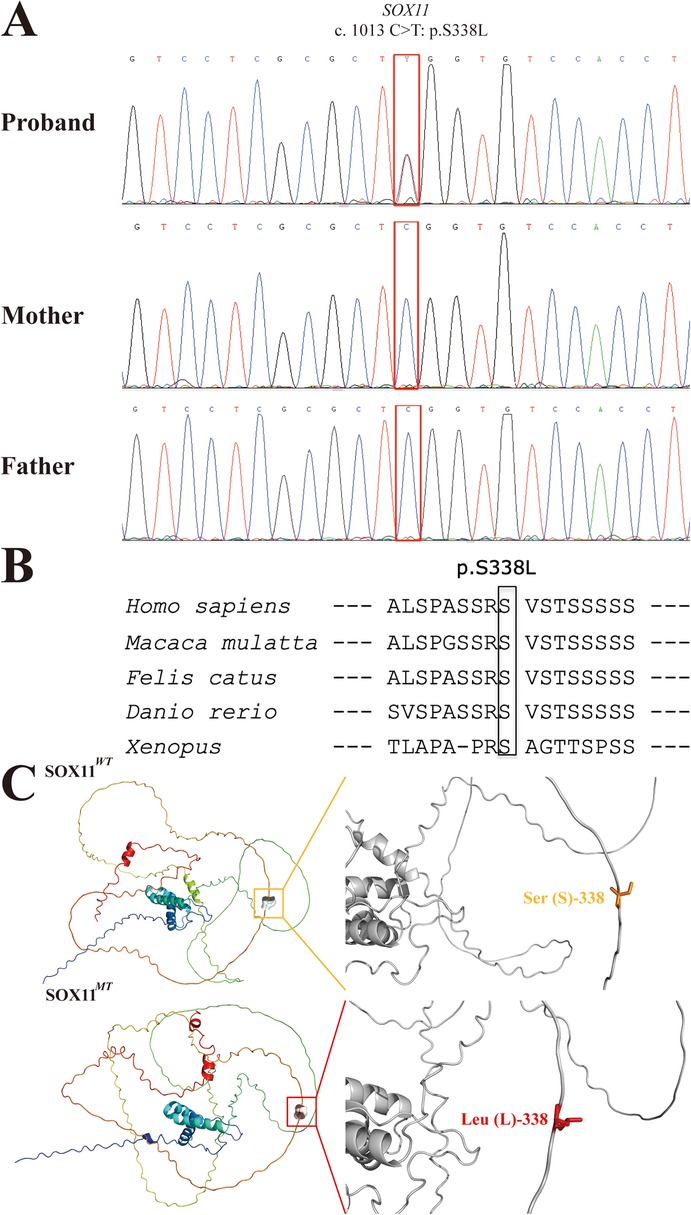 Genetic analysis showing a sequence chromatogram for the SOX11 gene indicating a c.1013C greater than T mutation in the proband, with normal sequences in the mother and father. A sequence alignment compares the affected sequence across different species, highlighting the conserved region altered by mutation. Structural models depict wild-type and mutant SOX11 proteins, zooming in on the mutation site where serine is replaced by leucine at position 338.