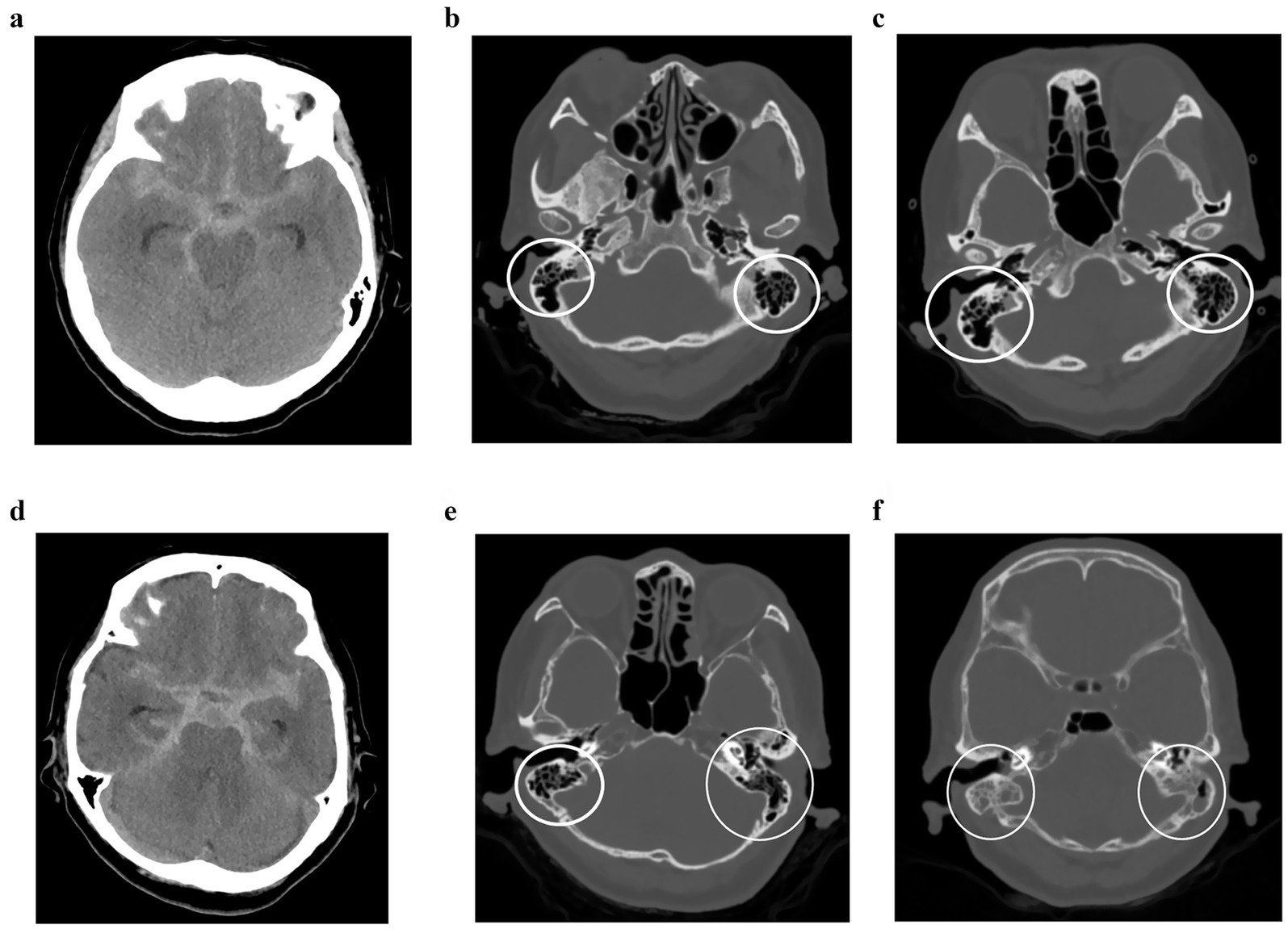 Six-panel medical image showing CT scans of the head. Panels a, b, c, and e highlight certain areas with circles. Panels d and f show axial views without highlighted regions. Each scan reveals variations in skull and brain structures.