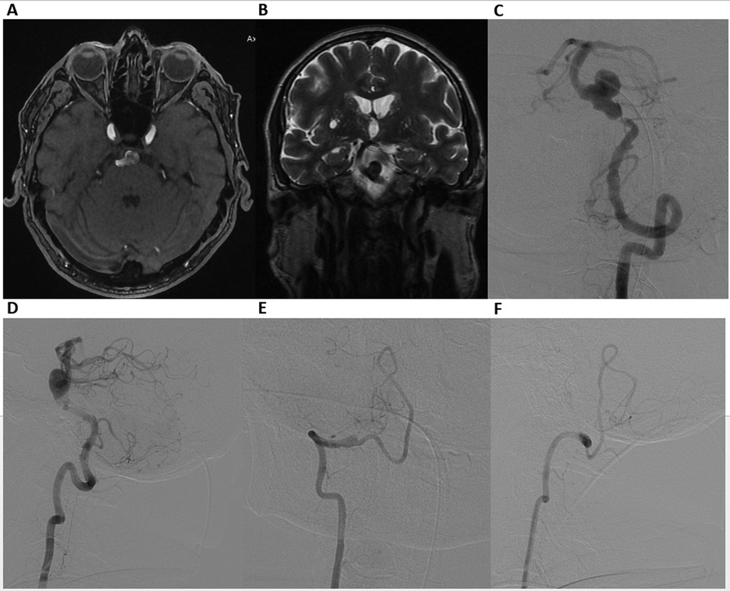 MRI and angiographic images of a human brain. Panel A shows an axial MRI scan, Panel B displays a coronal MRI scan. Panels C to F present angiograms: Panel C shows an aneurysm in a blood vessel; Panels D to F illustrate subsequent stages of the vessel post-intervention.