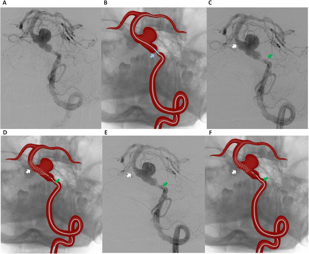 Angiographic images and diagrams in a panel showing the treatment of an aneurysm. Images A, C, and E display angiograms of cerebral vasculature with an aneurysm. Images B, D, and F are diagrams illustrating the aneurysm's location and treatment. Blue, white, and green arrows point to specific features such as the aneurysm, blood vessels, and the placement of a stent or flow diverter. Red vessels are highlighted for clarity.