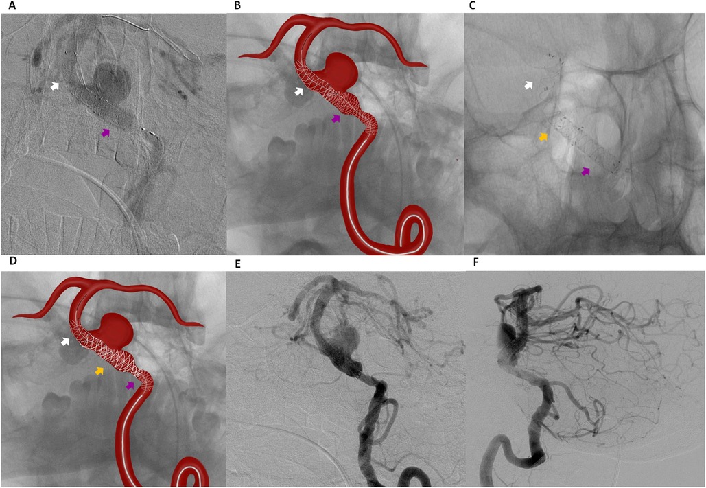 Composite image of six panels showing vascular imaging and intervention. Panel A: grayscale angiogram highlighting a vessel with arrows in white and purple. Panel B: illustration of a stent placement in red overlaid on an angiogram, with white and purple arrows. Panel C: grayscale image with visible stent, marked by white, yellow, and purple arrows. Panel D: similar to panel B with additional yellow arrow. Panels E and F: grayscale images showing detailed views of cerebral vasculature.