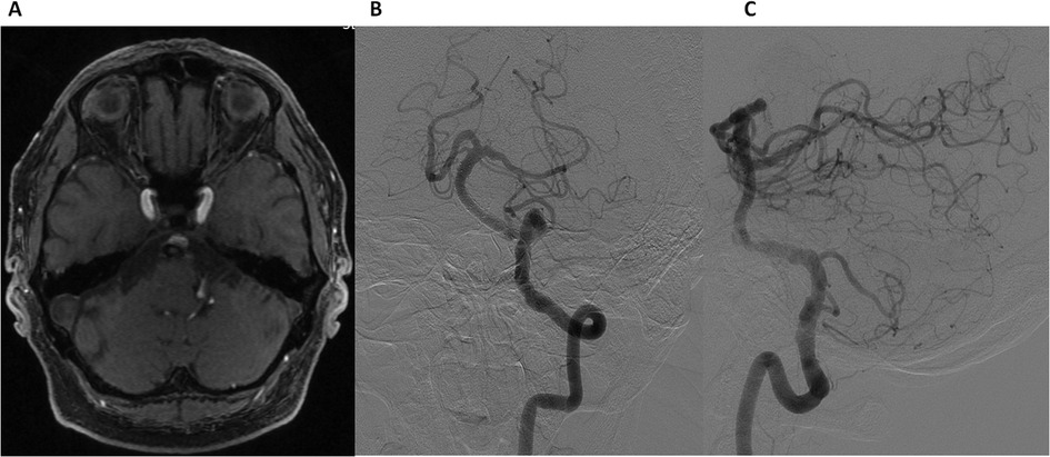 MRI and angiography images showing:\n\nA. An axial T1-weighted MRI scan of the brain, displaying symmetrical structures and some enhanced areas.\n\nB. An angiogram highlighting cerebral vasculature with visible major artery.\n\nC. A further angiogram showing detailed network of cerebral vessels, illustrating different blood flow directions.