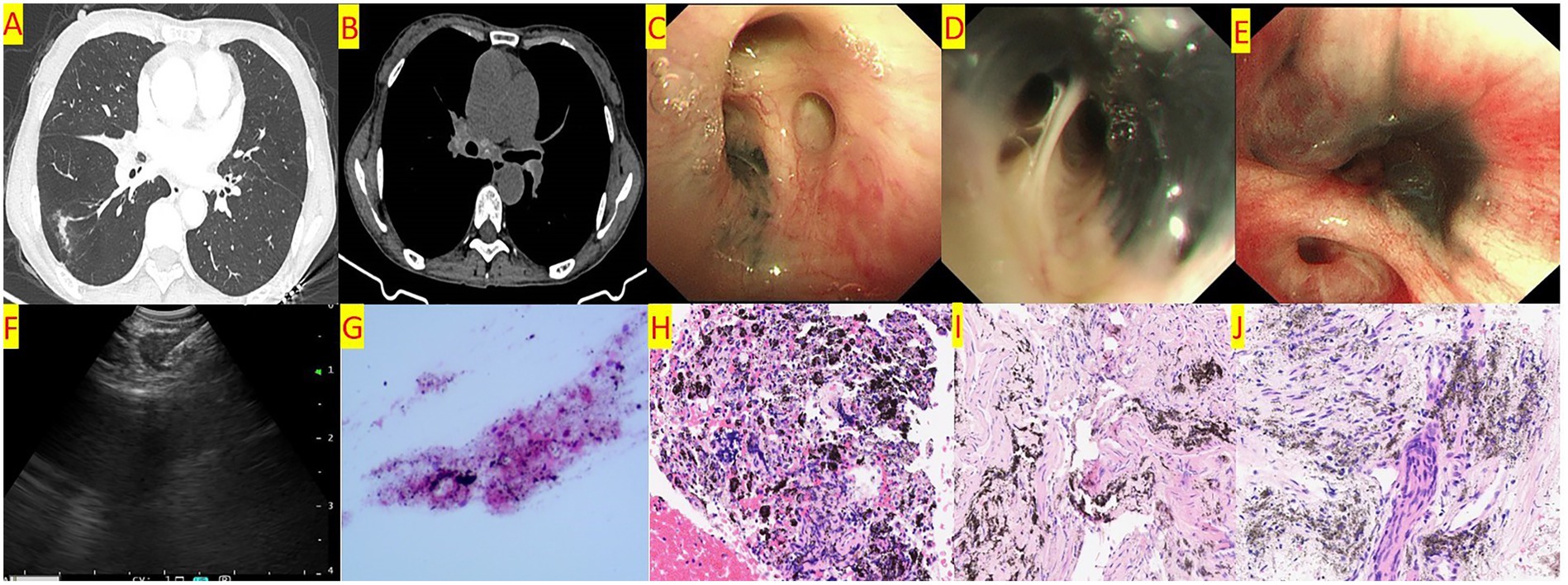 A series of medical images. A Chest CT shows a linear high-density shadow in the right lower lobe and stenosis of the bronchial orifice of the right middle lobe. B Chest CT shows enlarged lymph nodes in the mediastinum and hilar region, with calcification visible. C Bronchoscopy shows pigmentation at the orifice of the right upper lobe anterior segment, with no stenosis of the orifice. D Bronchoscopy shows pigmentation at the orifice of the right middle lobe inner and outer segments, with mild stenosis of the orifice. E Bronchoscopy shows pigmentation at the orifice of the right lower lobe basal segment, with severe stenosis of the orifice. F EBUS-TBNA. G Cytological examination of the aspirated material from the enlarged lymph nodes shows lymphocytes and pigmentation. H Pathological examination of the aspirated material from the enlarged lymph nodes shows a background of coagulation with pigmentation, aggregation of histiocytes, and a few lymphocytes. I Histopathological examination of biopsy forceps biopsy shows widened alveolar septa, scattered lymphocyte aggregation, and pigmentation. J Histopathological examination of the enlarged lymph nodes shows focal pigmentation, and a few epithelioid cells are seen in the inflammatory necrosis. TB-DNA testing is positive.
