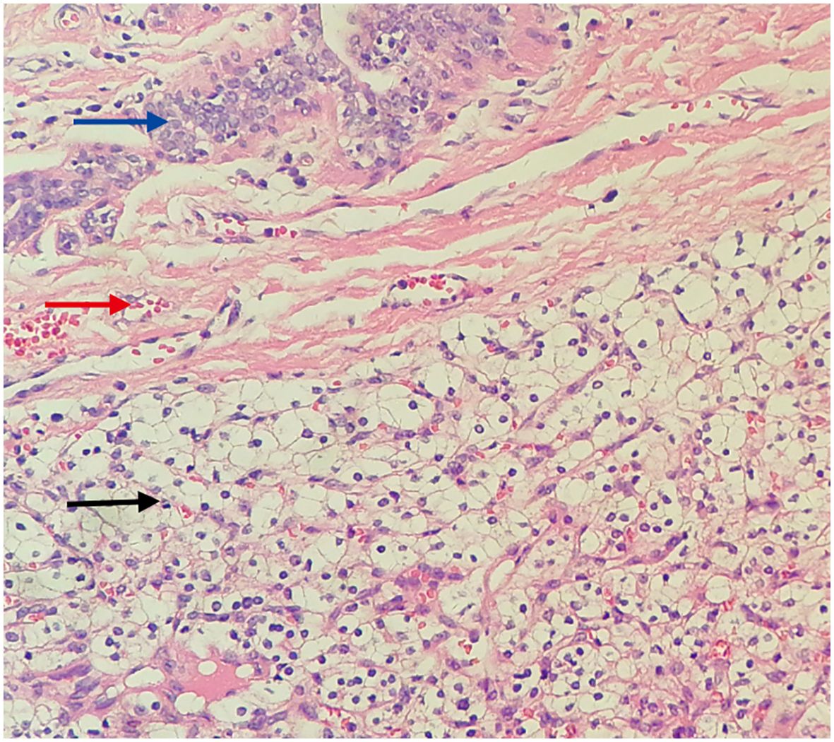 Microscopic image of tissue under a hematoxylin and eosin stain. Different cellular structures are present, with arrows indicating specific areas. A blue arrow points to a dense cluster of small cells, a red arrow indicates a grouping of slightly larger cells, and a black arrow points to adipose cells characterized by large white spaces, surrounded by purple-stained nuclei.