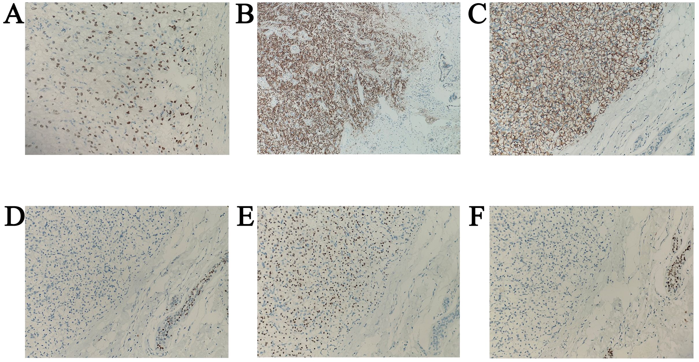 Histological images A to F show tissue samples with varying levels of staining, indicating different protein or cell presence. Images A, B, and C display darker staining, suggesting higher concentration or expression. Images D, E, and F show lighter staining, indicating lower levels or absence. Each image reveals the distribution patterns in a cellular matrix, useful for comparative analysis in biological research.