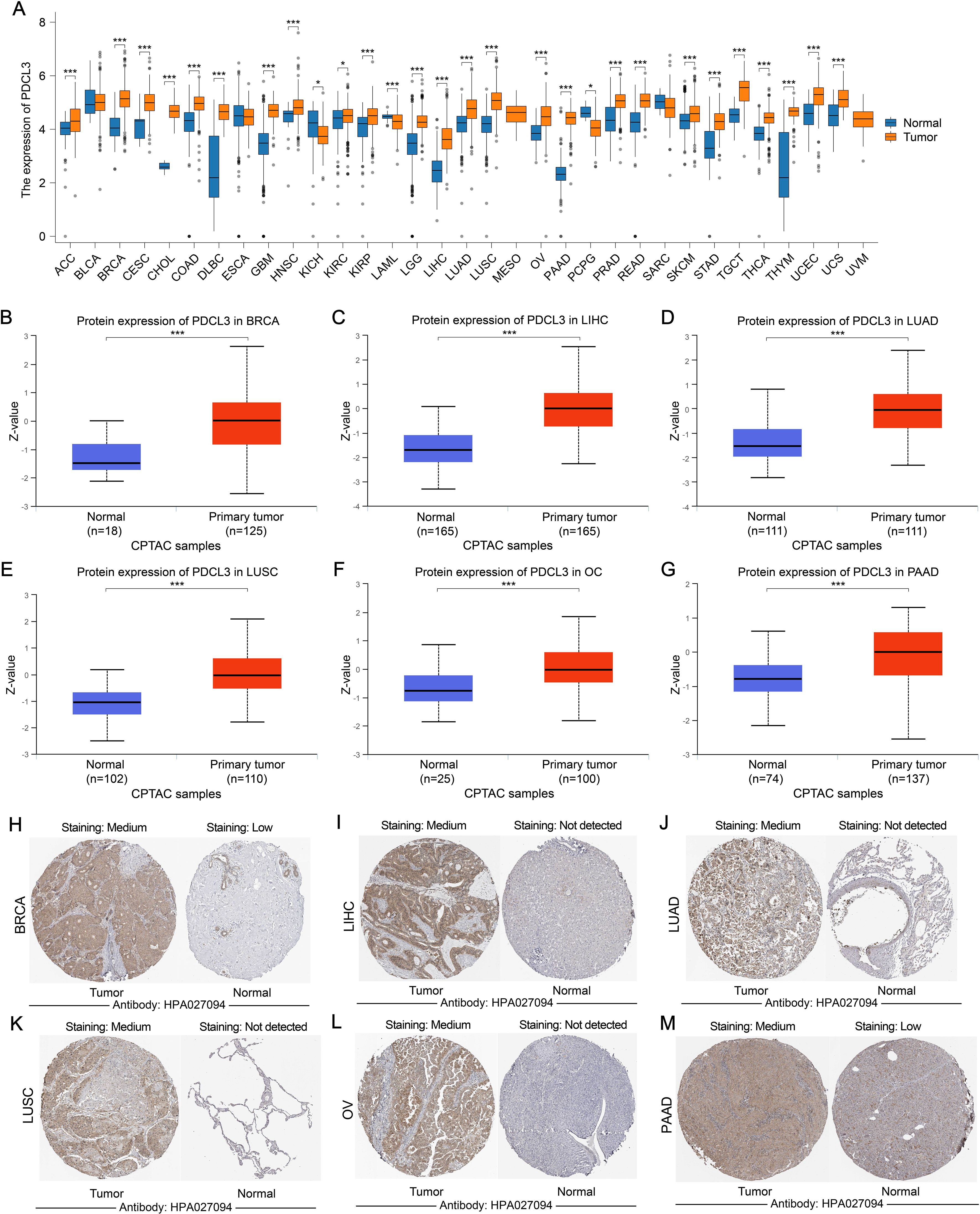 Chart A shows the protein expression levels of PDCL3 across various cancer types, comparing tumor (orange) and normal (blue) tissues. Box plots B-G display detailed comparisons for specific cancers: BRCA, LIHC, LUAD, LUSC, OC, and PAAD, indicating higher PDCL3 expression in tumors. Images H-M are tissue microarrays showing PDCL3 staining levels in tumor versus normal tissues across BRCA, LIHC, LUAD, LUSC, OV, and PAAD, using antibody HPA027094, with medium staining in tumors and low or undetected in normal tissues.