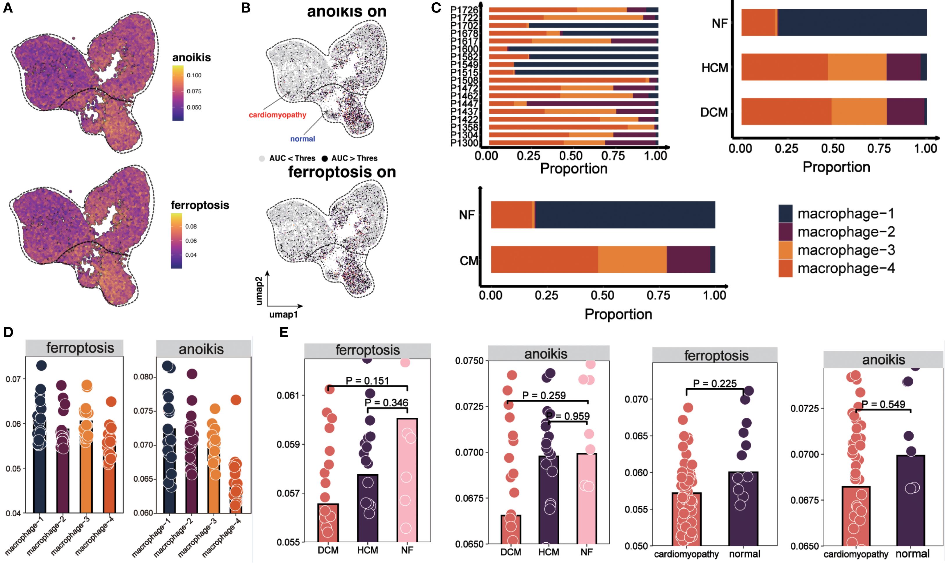 Diagram showcasing various data visualizations related to anoikis and ferroptosis. Panel A displays UMAP plots with color gradients indicating the levels of anoikis and ferroptosis. Panel B shows the UMAP distribution of cardiomyopathy versus normal tissues. Panel C contains bar graphs indicating the proportion of macrophage types across NF, HCM, and DCM conditions. Panel D features dot plots for ferroptosis and anoikis in different macrophage types. Panel E presents grouped bar and dot plots comparing DCM, HCM, NF, and cardiomyopathy versus normal, highlighting statistical differences.