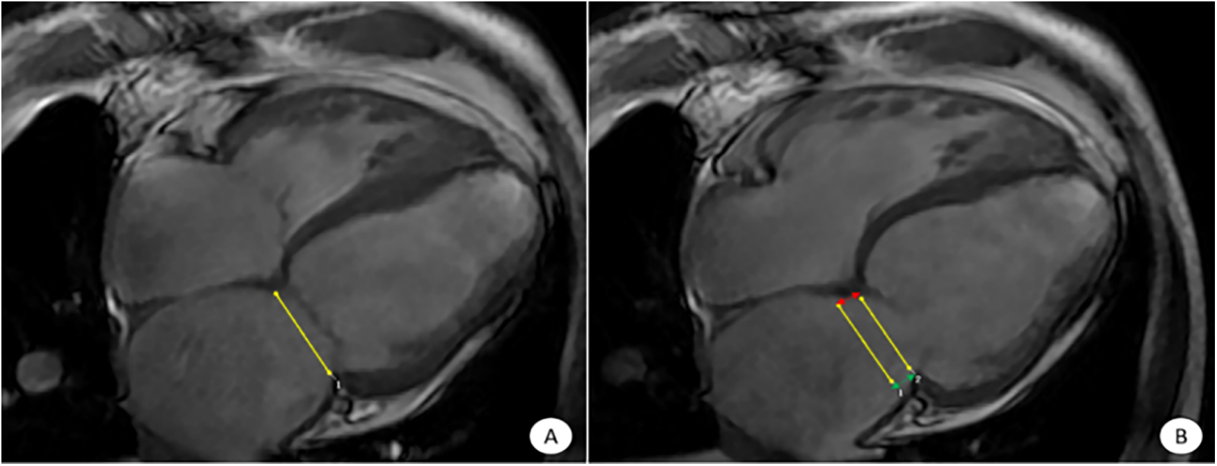 MRI scans of a heart depicting measurements with yellow lines. Image A displays one yellow line across the heart, while Image B displays two parallel yellow lines, each with red and green markers at their ends.
