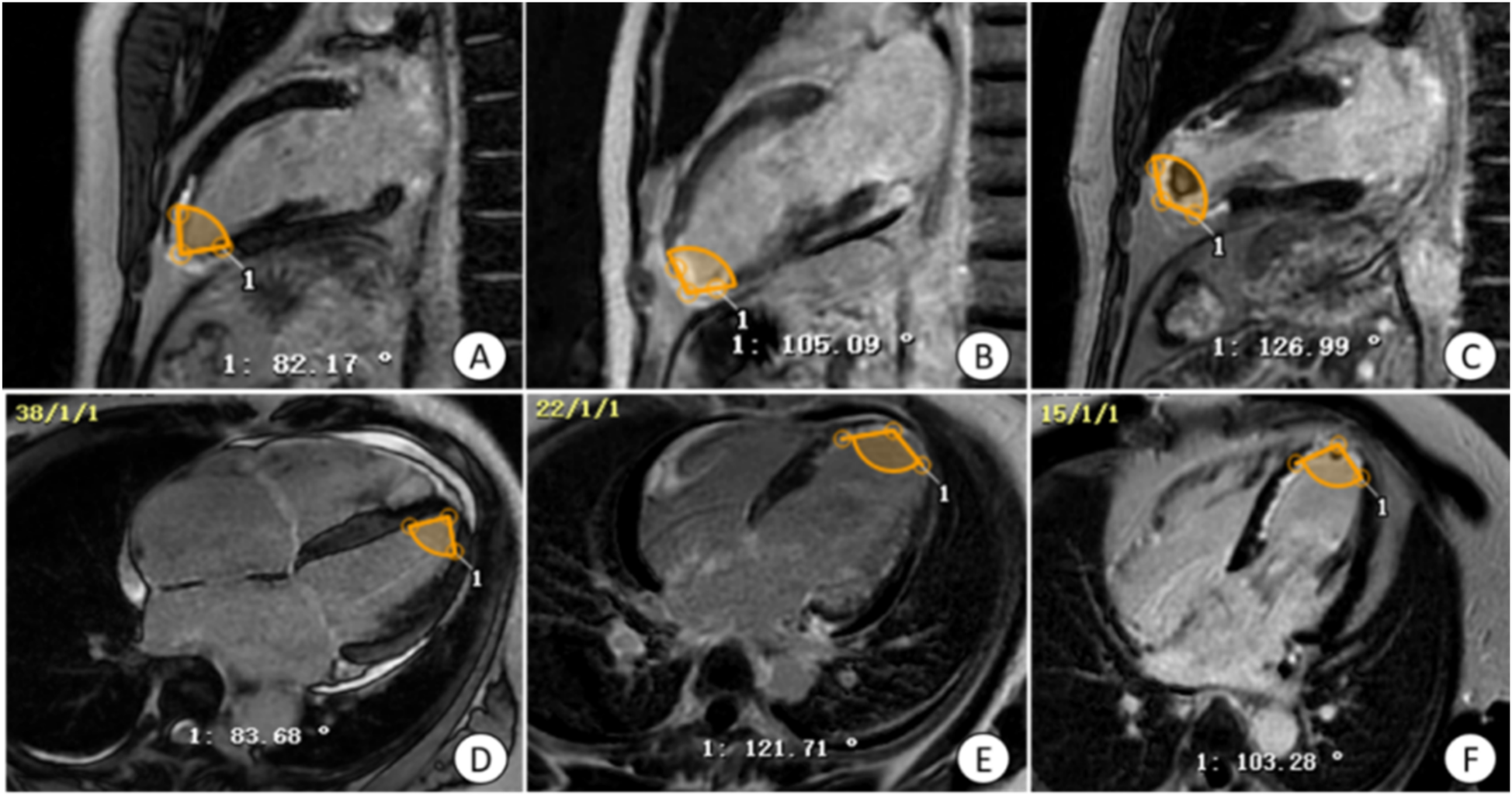 MRI images of a heart shown in sagittal and axial views, illustrating variations in angles marked by orange outlines. Panels labeled A to F display different orientations and measurements in degrees, indicating distinct heart chamber angles.