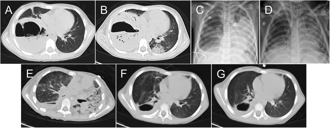 Chest images obtained during and after the patient's hospital stay in sequence. The images reveal the changes of pulmonary lesions.