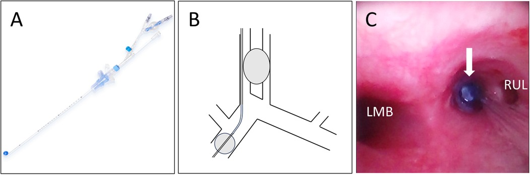 Endobronchial blocker placement. Panel A shows a close-up of the endobronchial blocker. Panel B is a diagram illustrating the blocker's placement in the bronchial tree. Panel C is a bronchoscopic view the blocker's placement in the bronchial tree.