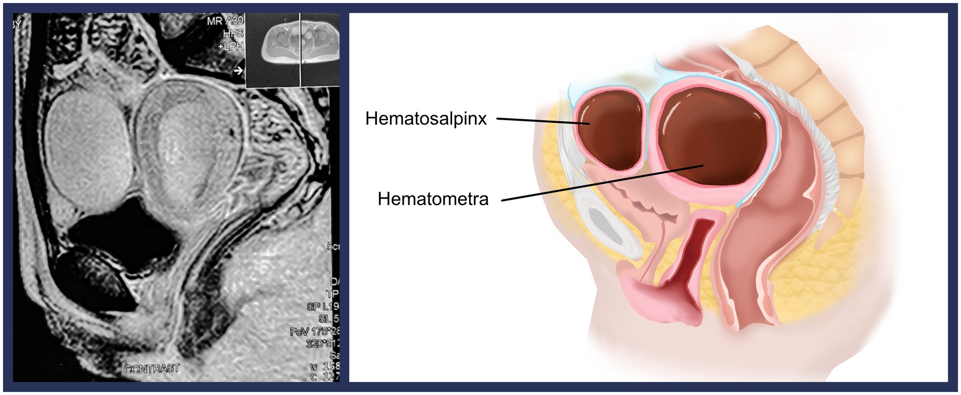 MRI scan and medical illustration depict hematosalpinx and hematometra. The left side shows the MRI with fluid-filled structures, while the right illustration labels the uterus and fallopian tube with accumulated blood.