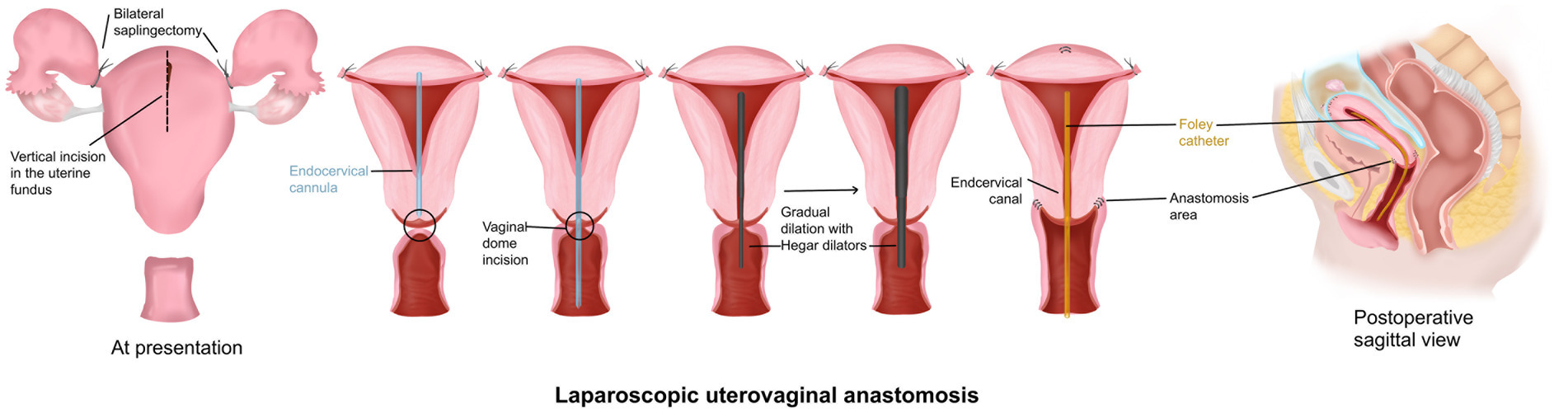 Diagram illustrating laparoscopic uterovaginal anastomosis. The sequence shows bilateral salpingectomy, vertical incision in the uterine fundus, endocervical cannula insertion, vaginal dome incision, gradual dilation with Hegar dilators, and postoperative sagittal view with a Foley catheter in the anastomosis area.