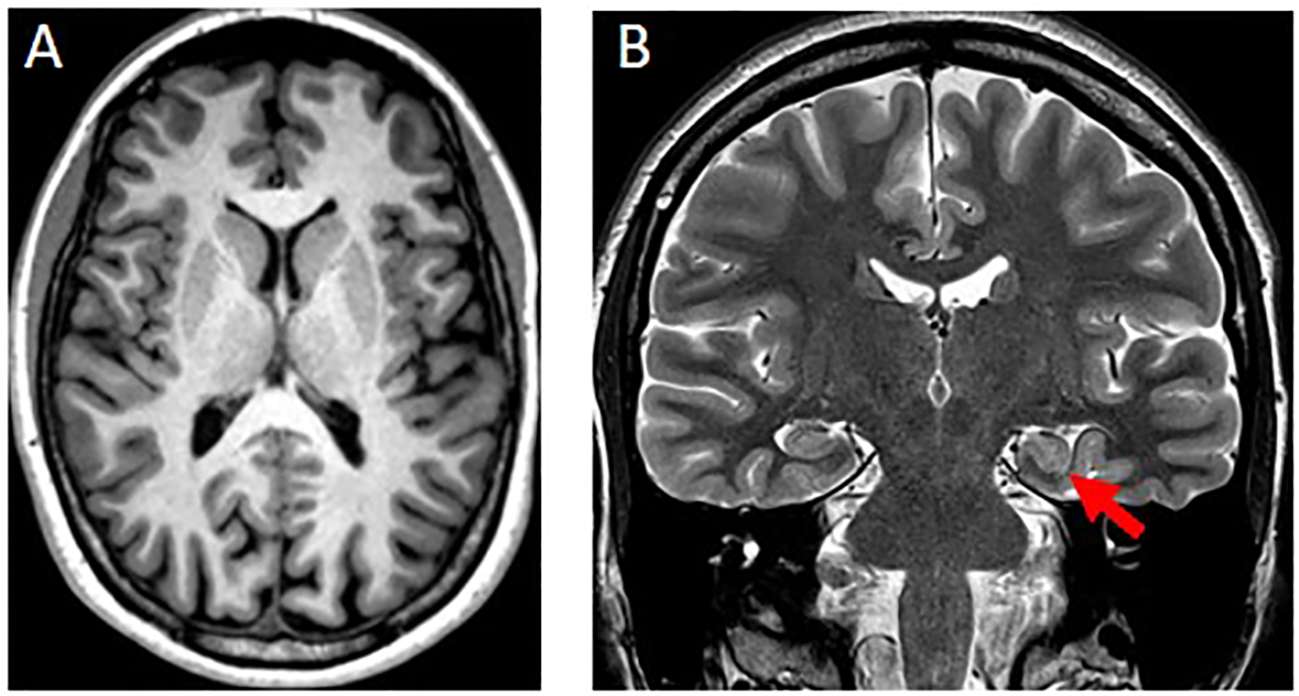 MRI scans of a brain in two panels. Panel A shows a horizontal cross-section, while Panel B shows a vertical cross-section with a red arrow pointing to a specific brain region.