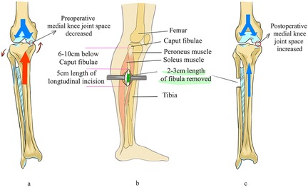 Left panel: Inferior displacement of the fibula causes uneven load distribution across the knee joint, resulting in medial compartment osteoarthritis with joint space narrowing. Middle panel: Fibular osteotomy procedure is performed. Right panel: Postoperative restoration of balanced load distribution over the tibial plateau leads to normalization of the medial joint space.