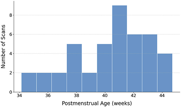 Bar chart depicting the number of scans by postmenstrual age in weeks. The x-axis ranges from 34 to 44 weeks, and the y-axis shows the number of scans, with the highest frequency occurring at 41 weeks.
