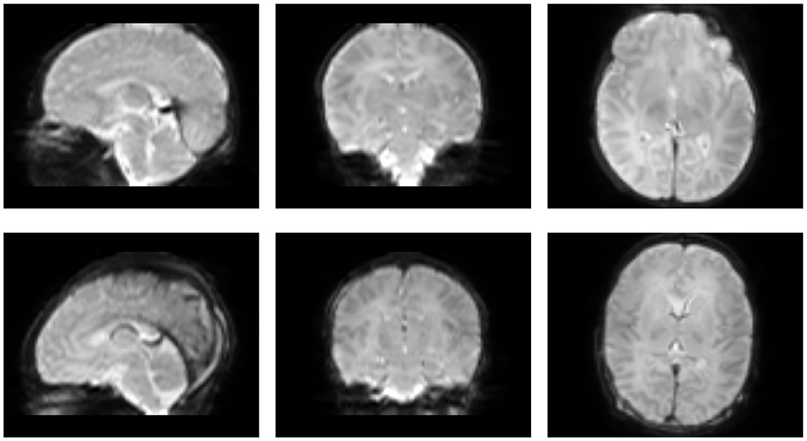 Two MRI brain scans are displayed in two rows of three. The top row shows the brain in sagittal, coronal, and axial views for the first example. The bottom row mirrors these views for the second example.