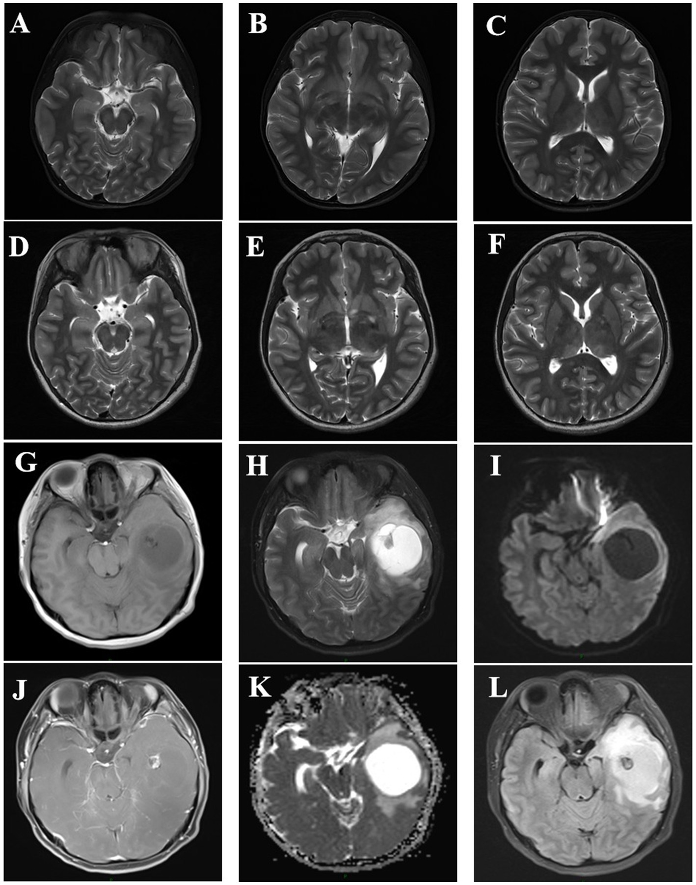 Twelve MRI brain scans labeled A to L, showing different axial views. Images A to F display consistent brain structures, whereas G to L reveal a significant abnormality, appearing as a bright circular mass in the temporal region. These scans highlight varying contrasts and tissues.