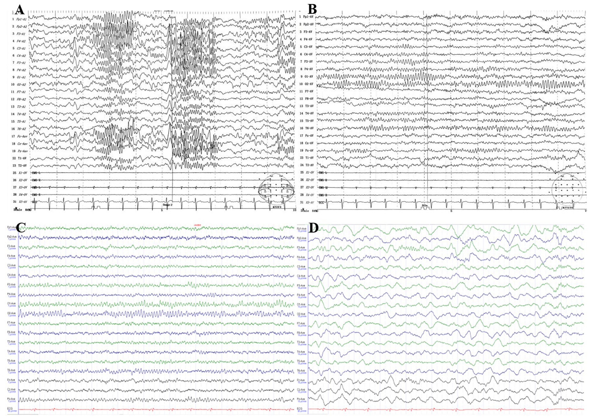 Four EEG waveform graphs labeled A, B, C, and D. Graph A shows dense, irregular wave patterns with prominent spikes. Graph B displays more regular but varied waveforms, with a notable cluster in the middle. Graph C features consistent, smaller oscillations. Graph D presents larger, more erratic waveforms. Each graph is marked with channel labels on the left.