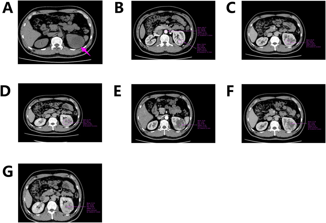 Seven CT scan images labeled A to G show axial views of the abdomen. Image A highlights a region with a pink arrow. Images B to G have annotations in pink text identifying various measurements and features on the kidneys and surrounding tissues. Each image provides a different section view, with emphasis on specific areas.