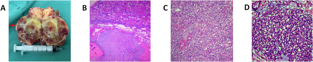 Panel A shows a bisected tissue specimen with distinct yellowish and reddish areas beside a syringe for scale. Panel B is a histological image displaying cellular structures with varying density and staining patterns. Panel C depicts a higher magnification of cellular tissue with a more uniform appearance. Panel D presents a close-up view of densely packed cells with prominent staining.