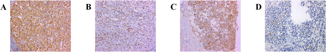 Four panels labeled A to D show histological samples with varying staining patterns. Panel A shows a dense brown staining. Panel B shows moderate brown staining with more spaces. Panel C shows patchy brown staining on the right side. Panel D shows predominantly blue staining with minimal brown areas.