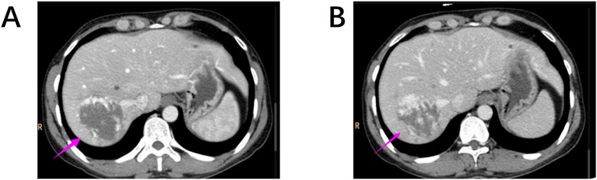 CT scans labeled A and B show cross-sectional views of the liver. Pink arrows point to areas of interest on the liver surface, highlighting regions with differing textures or densities, possibly indicating lesions or abnormalities.
