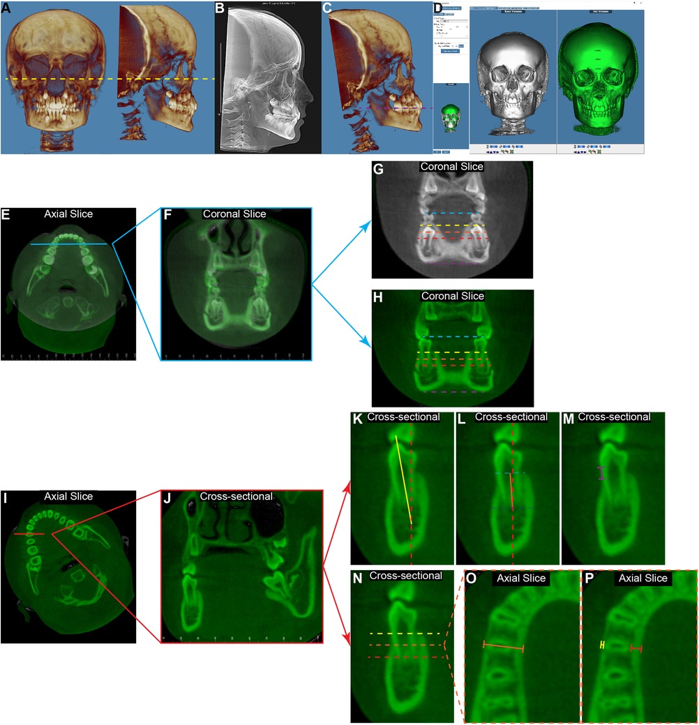 Cone-Beam Computed Tomography of the human skull. Images A to D show the image oriented to different planes, reconstructed and superimposed. Images E to P show series of linear and angular measurements with colored lines for analysis.