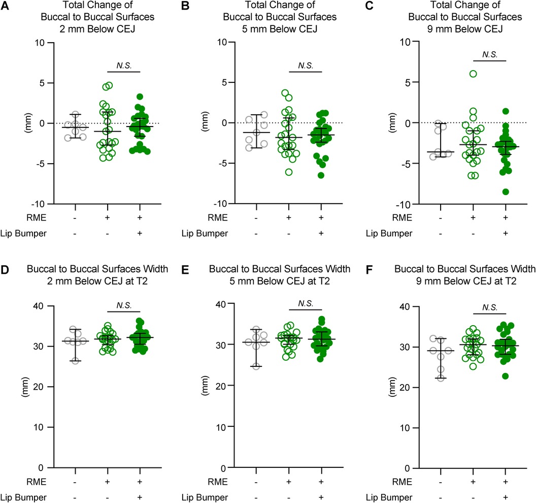 Six scatter plots displaying changes in buccal surface transverse measurements at different vertical levels relative to cementoenamel junction at canine with and without RME and lip bumper. Images A to C depicts total changes while images D to F show difference at T2.