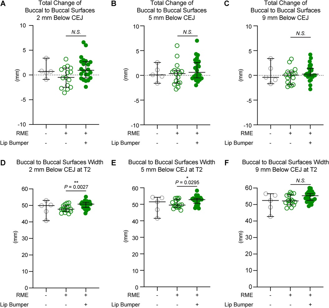 Six scatter plots displaying changes in buccal surface transverse measurements at different vertical levels relative to cementoenamel junction at second premolar with and without RME and lip bumper. Images A to C depicts total changes while images D to F show difference at T2.