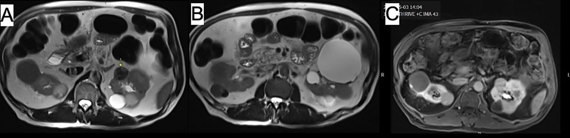Three-panel MRI scan showing transverse sections of the abdomen. Panel A shows a structured mass marked with an arrow. Panel B displays a large cystic area. Panel C depicts multiple irregular lesions.