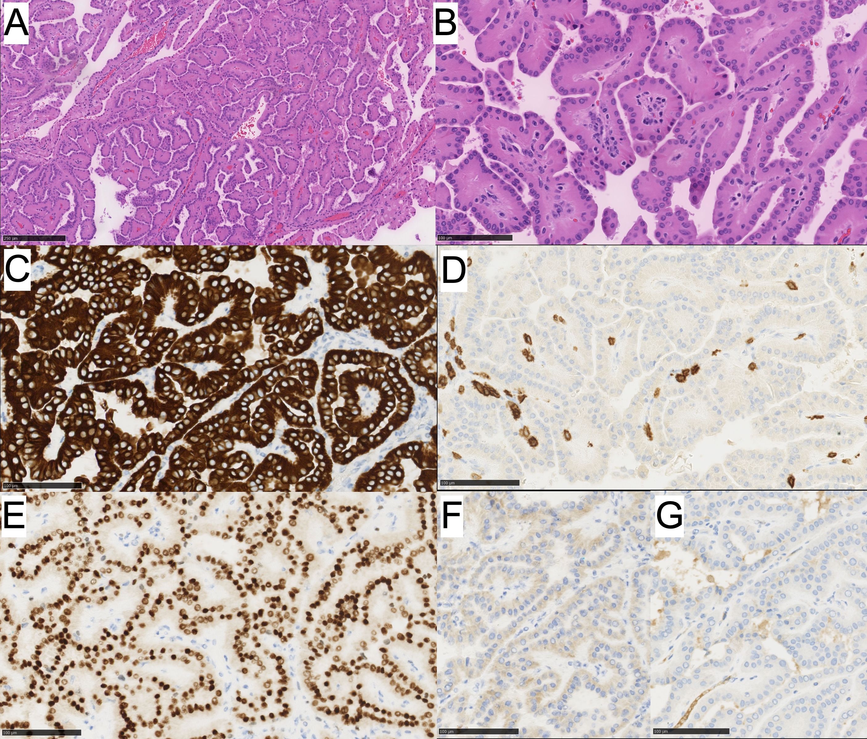Histological images labeled A to G show various tissue samples. A and B depict tissue stained in pink and purple, highlighting cellular structures. C shows dark brown stained areas, indicating high protein expression. D exhibits lighter staining with scattered dark spots. E features numerous dark brown spots on a lighter background. F and G display tissue with pale staining and some brown areas. Each image includes a scale bar for reference.